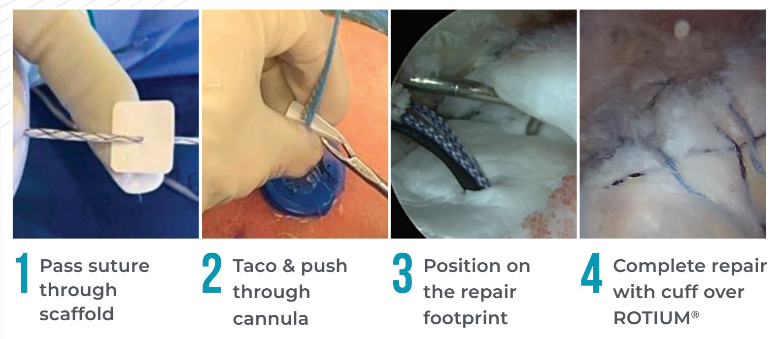 Atreon_procedure